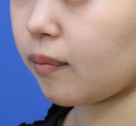 20代女性の人中短縮(リップリフト) Before 症例写真