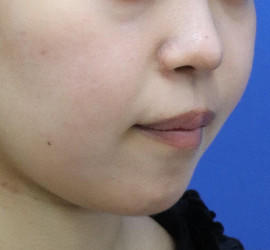 20代女性の人中短縮(リップリフト) Before 症例写真