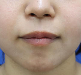 20代女性の人中短縮(リップリフト) Before 症例写真