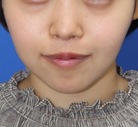 20代女性の唇・口元の整形 After 症例写真