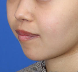 20代女性の人中短縮(リップリフト) After 症例写真