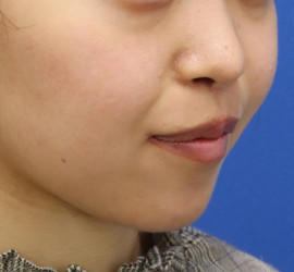 20代女性の人中短縮(リップリフト) After 症例写真