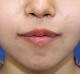 20代女性の人中短縮(リップリフト) After 症例写真