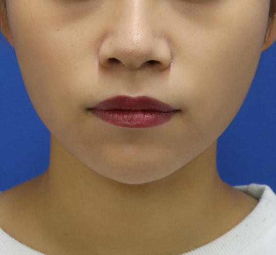20代女性の顔の脂肪吸引 After 症例写真