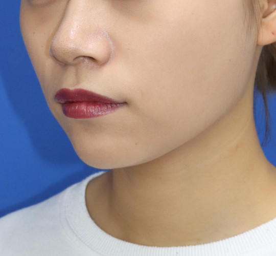 20代女性の顔の脂肪吸引  After 症例写真