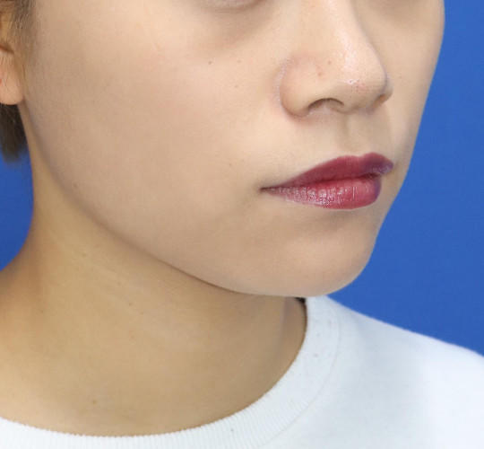 20代女性の顔の脂肪吸引  After 症例写真