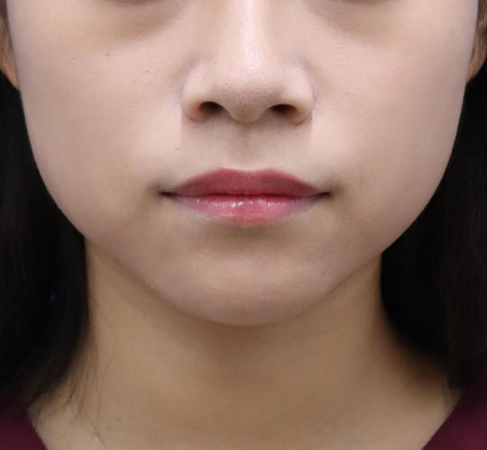 20代女性の顔の脂肪吸引 Before 症例写真