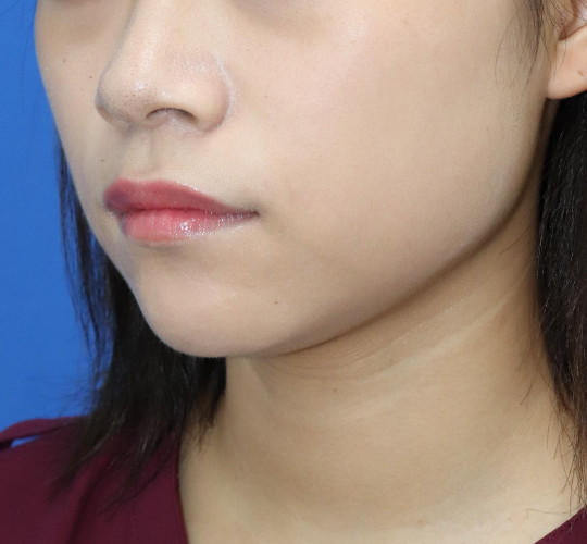 20代女性の顔の脂肪吸引  Before 症例写真