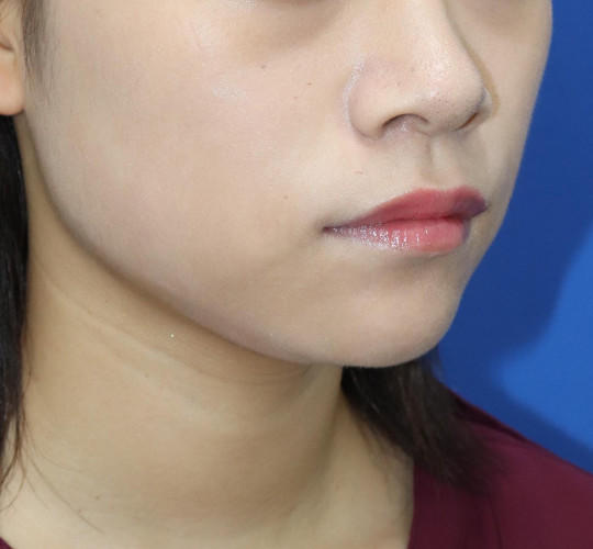 20代女性の顔の脂肪吸引  Before 症例写真