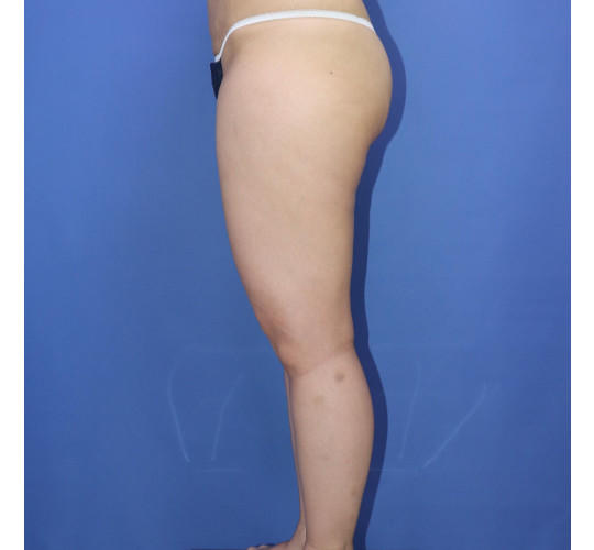 30代女性の脂肪吸引 Before 症例写真