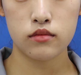 20代女性の唇・口元の整形 After 症例写真