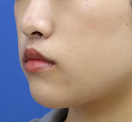20代女性の人中短縮(リップリフト) After 症例写真