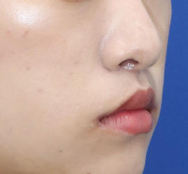 20代女性の人中短縮(リップリフト) After 症例写真