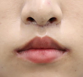 20代女性の人中短縮(リップリフト) After 症例写真