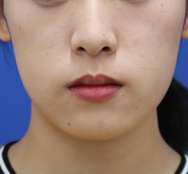 20代女性の唇・口元の整形 Before 症例写真