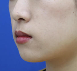 20代女性の人中短縮(リップリフト) Before 症例写真