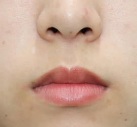 20代女性の人中短縮(リップリフト) Before 症例写真