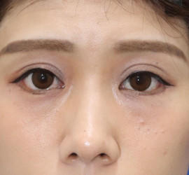 20代女性のタレ目・でか目形成 After 症例写真