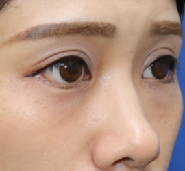 20代女性の二重整形・目元の整形 After 症例写真