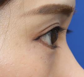 20代女性のタレ目・でか目形成 After 症例写真