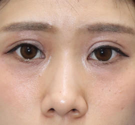 20代女性のタレ目・でか目形成 Before 症例写真
