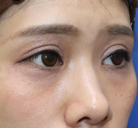 20代女性の二重整形・目元の整形 Before 症例写真