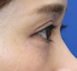 20代女性のタレ目・でか目形成 Before 症例写真