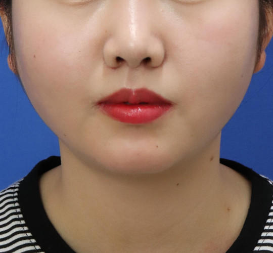 20代女性の人中短縮（リップリフト） After 症例写真