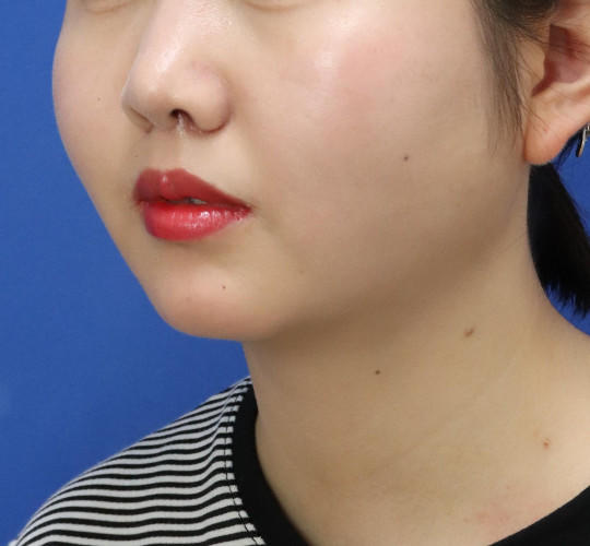 20代女性の鼻の整形 After 症例写真