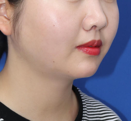 20代女性の人中短縮（リップリフト） After 症例写真