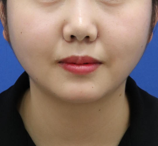20代女性の人中短縮（リップリフト） Before 症例写真