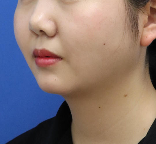 20代女性の鼻の整形 Before 症例写真