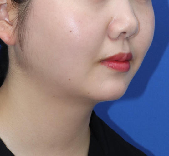 20代女性の人中短縮（リップリフト） Before 症例写真