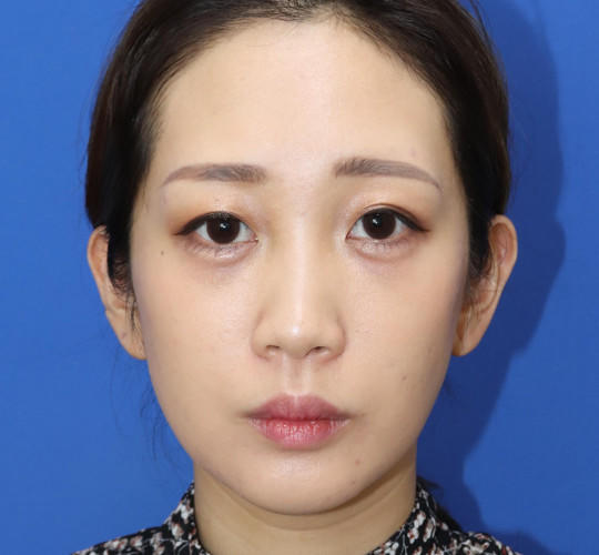20代女性の顔の脂肪吸引  After 症例写真
