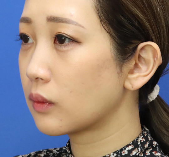 20代女性の顔の脂肪吸引  After 症例写真