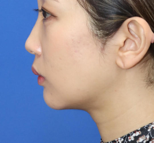 20代女性の顔の脂肪吸引  After 症例写真