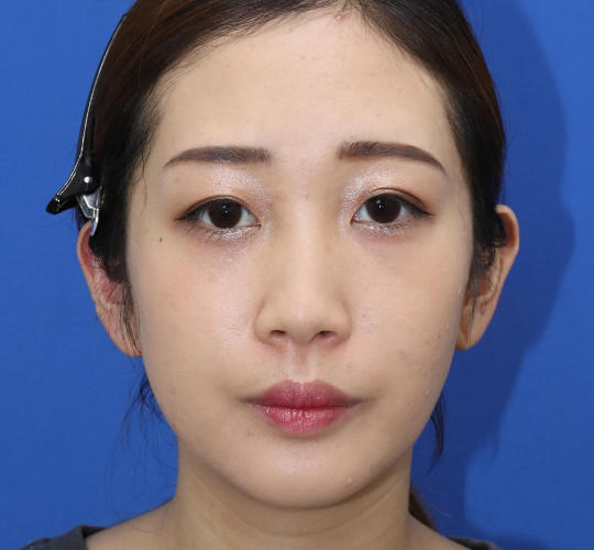 20代女性の顔の脂肪吸引  Before 症例写真