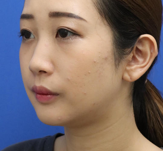 20代女性の顔の脂肪吸引  Before 症例写真