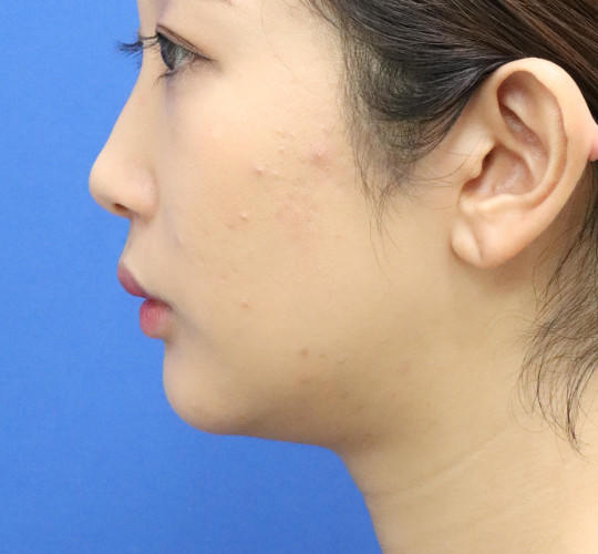 20代女性の顔の脂肪吸引  Before 症例写真