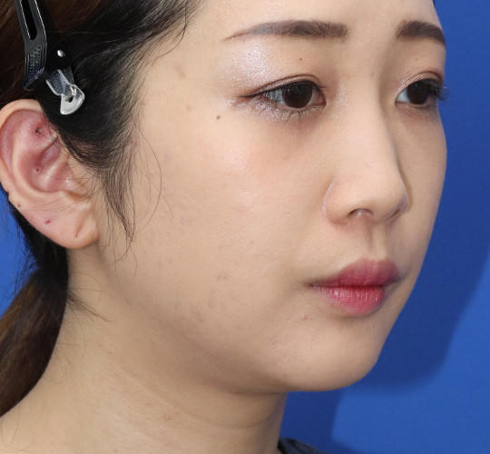 20代女性の顔の脂肪吸引 Before 症例写真
