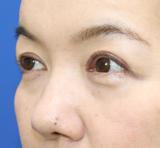 50代女性の眼瞼下垂 After 症例写真