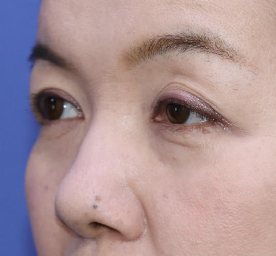 50代女性の眼瞼下垂 Before 症例写真