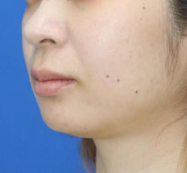 20代女性の人中短縮(リップリフト) Before 症例写真