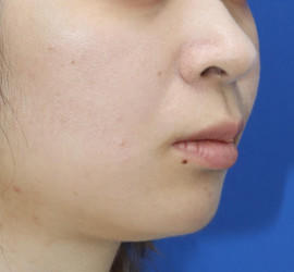 20代女性の人中短縮(リップリフト) Before 症例写真