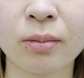 20代女性の人中短縮(リップリフト) Before 症例写真