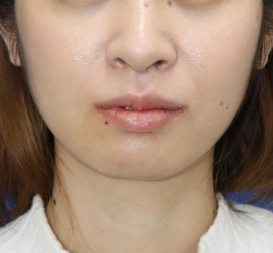 20代女性の鼻の整形 After 症例写真