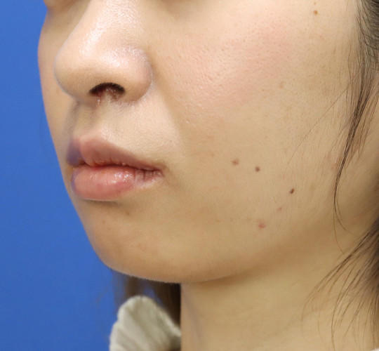 20代女性の人中短縮（リップリフト） After 症例写真