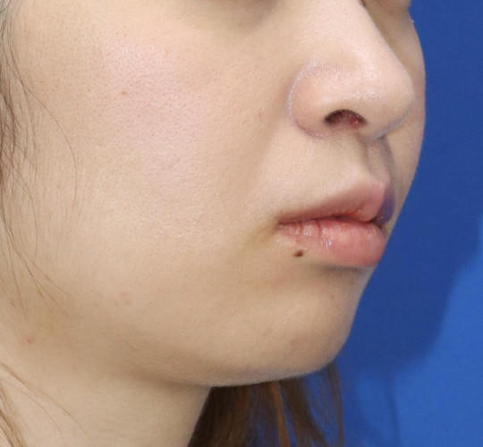 20代女性の人中短縮（リップリフト） After 症例写真