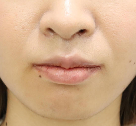 20代女性の人中短縮（リップリフト） After 症例写真