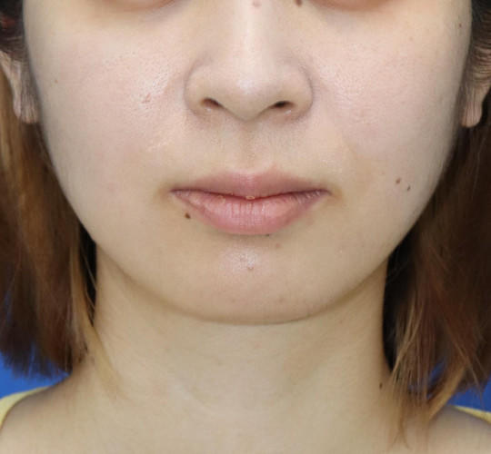 20代女性の鼻の整形 Before 症例写真